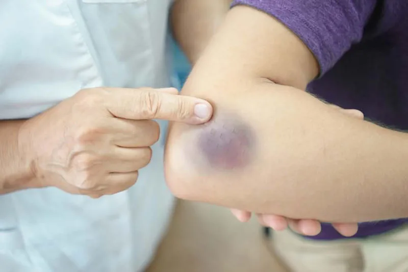 Xạ trị ung thư máu sống được bao lâu